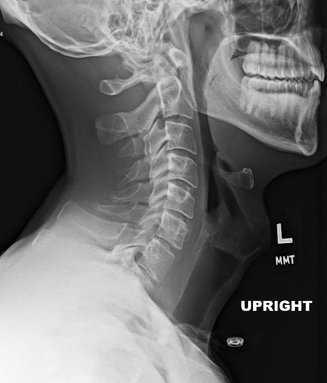 Cervical Spine X Ray Strategiesladeg