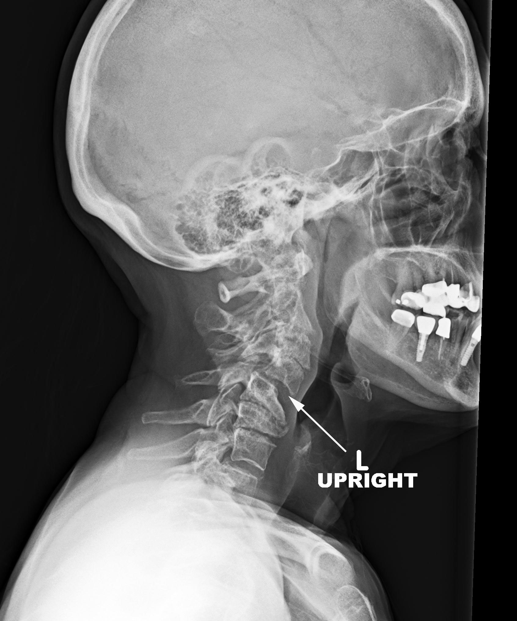 Cervical Degeneratinve Kyphosis Cervical Spine Denver Area