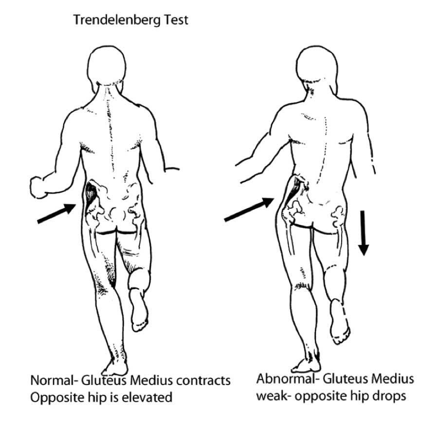Walking Disorders - How Nerve and Joint Injuries Change Gait