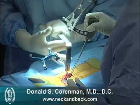 Transforaminal epidural steroid injection video