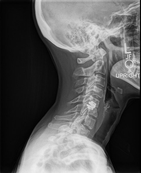 Lateral X-ray of displaced ADR