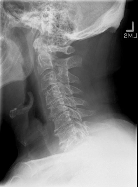 Lateral cervical X-ray