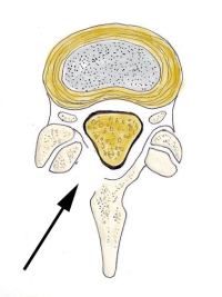 Illustration Of Hemilaminotomy