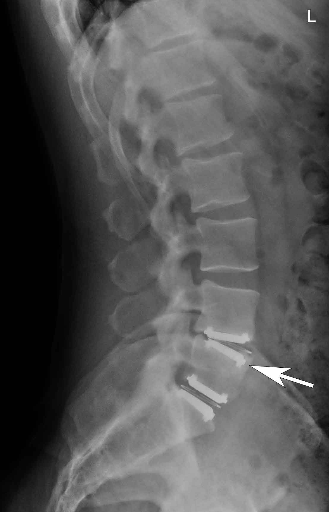 Normal Lumbosacral X Ray : Facet Imbrication Can Be A Cause of Sciatica - Innova Pain ... : The spine is divided into several sections.
