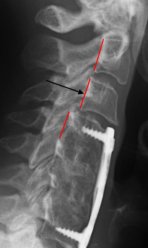 Lateral Xray Patient Neck Level Fusion C4