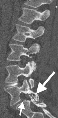 Degenerative Spondylolisthesis | Spine Surgeon