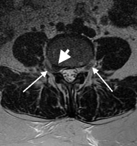 Far Lateral Disc Herniation | Spine Specialist