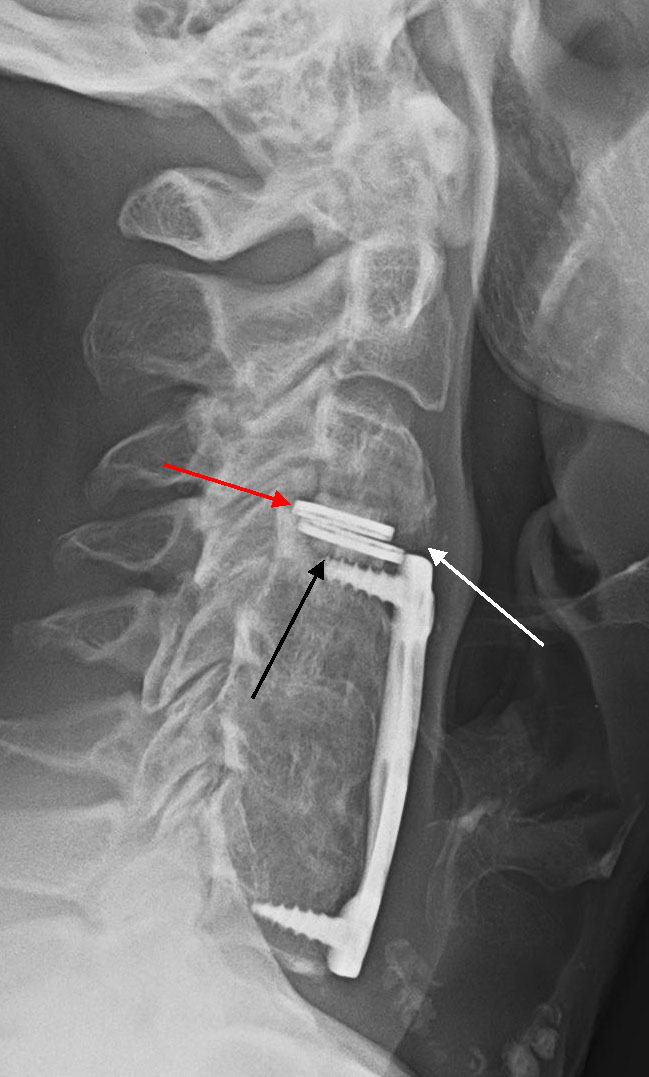 Failed Artificial Disc Replacement in Neck