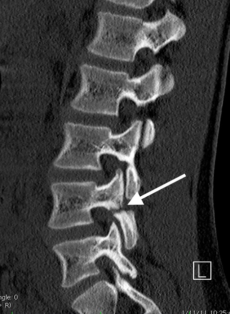 What Is A Pars Fracture Defect The Trauma Pro - vrogue.co