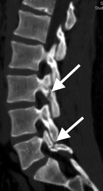 Lumbar Stress Fracture