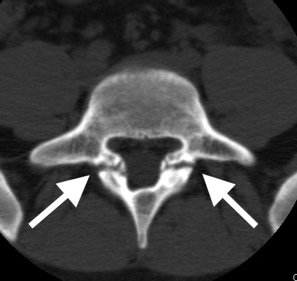 Pars Fracture Lumbar Spine