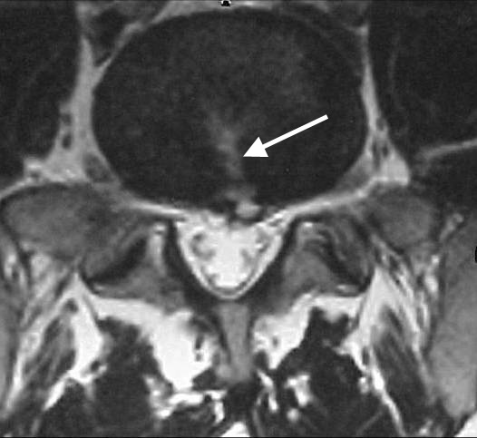 Axial MRI of Annular Tear | Disc Herniation