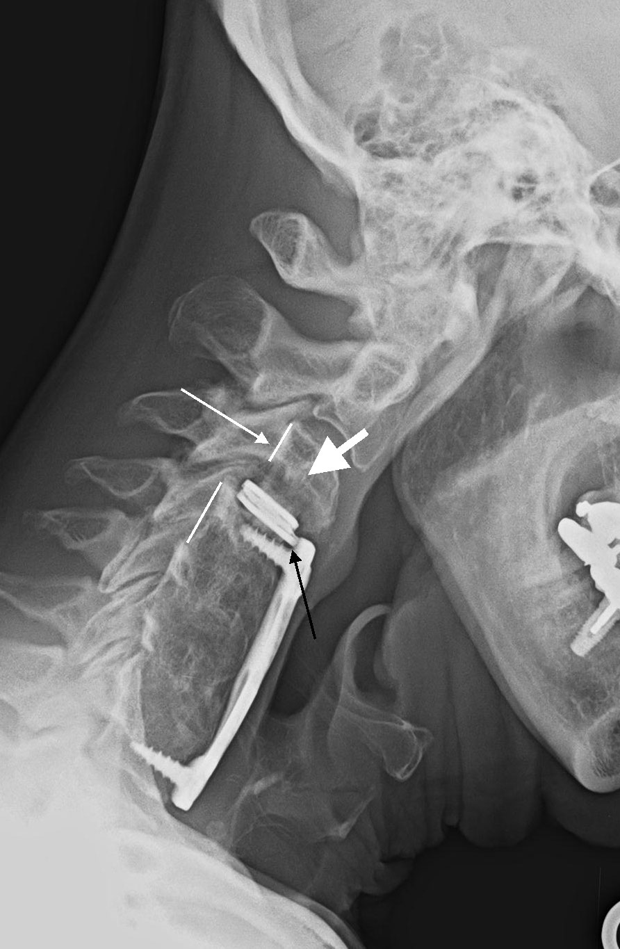 Failed Artificial Disc Replacement in Neck