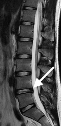 Lumbar Degenerative Disc Disease | Spine Specialist