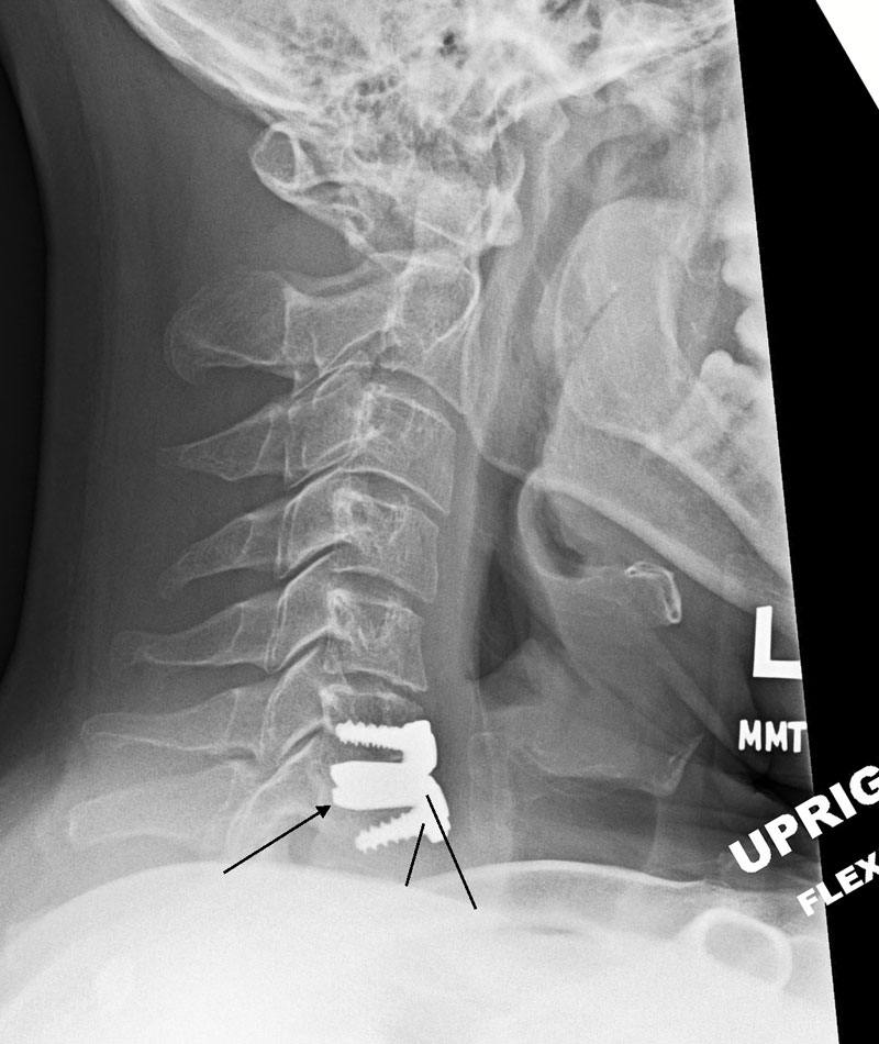 Lateral X-Ray Failed Artificial Disc