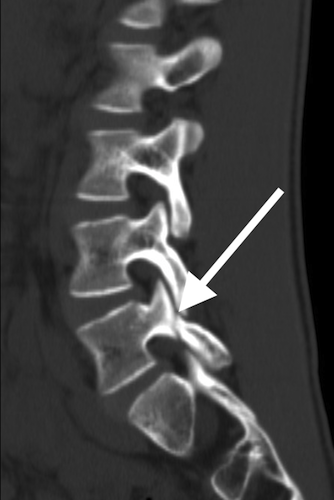 Spondylolysis In Children Pars Interarticularis Fracture Vail Spondylolysis In Children Pars Interarticularis Fracture Vail