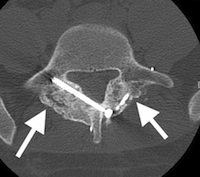 C-L5-axial-CT-scan-of-healed-pars-fractures