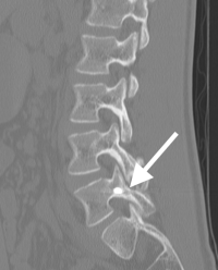 Surgical Repair Of Pars Interarticularis Fractures 