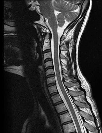 Anatomy of the Cervical Spine | Spine Anatomy | Vail, CO