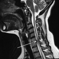 Anterior Cervical Decompression & Fusion (ACDF) | Spine Surgeon