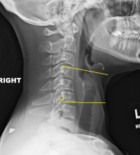 Cervical Degenerative Kyphosis | Spine Specialist