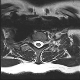 Anterior Cervical Decompression & Fusion (ACDF) | Spine Surgeon