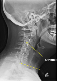 Cervical Degenerative Kyphosis | Spine Specialist