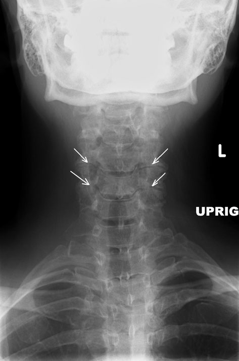 cervical-spine-instability-orthopaedicprinciples