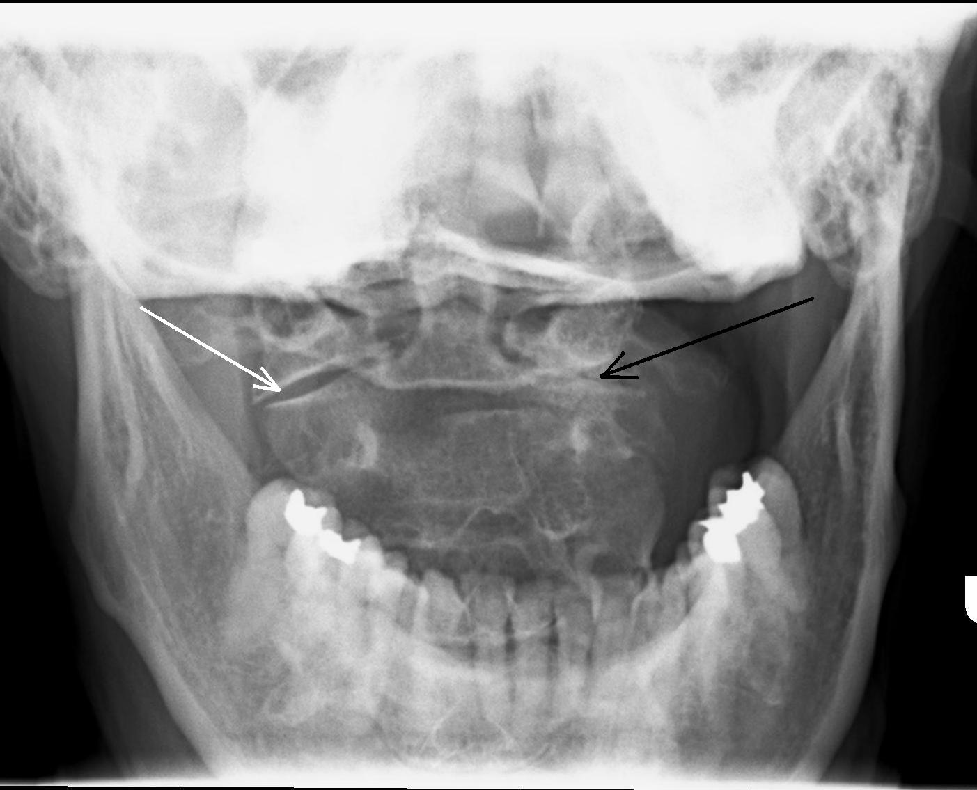 Uncovertebral Joint Hypertrophy