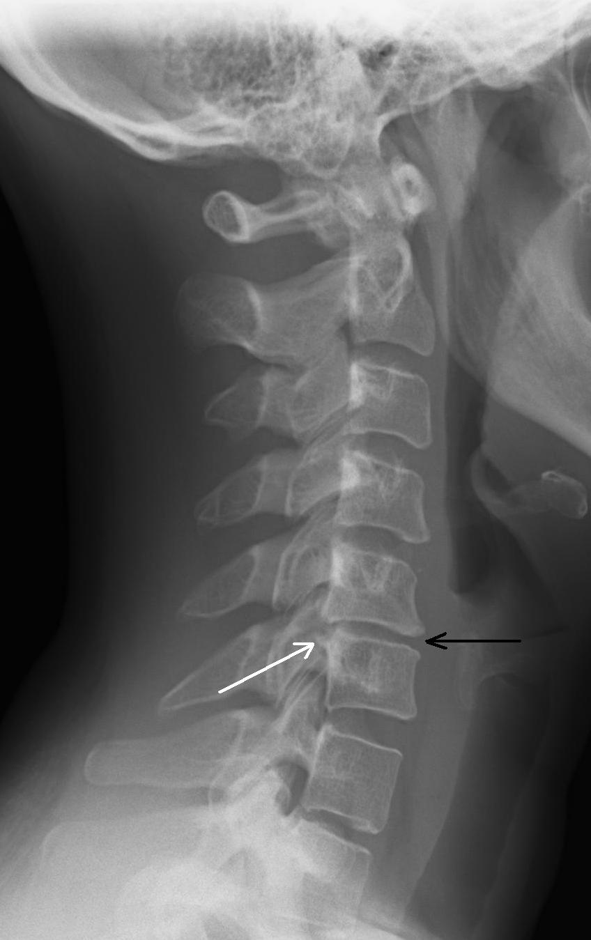 spine bulging disk xray