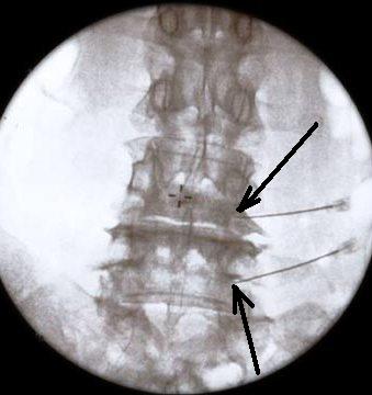 Selective nerve root block vs epidural steroid injection