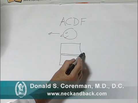 ACDF Explained