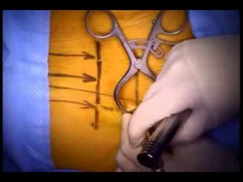 Far Lateral Disc Herniation Minimally Invasive Surgical Removal
