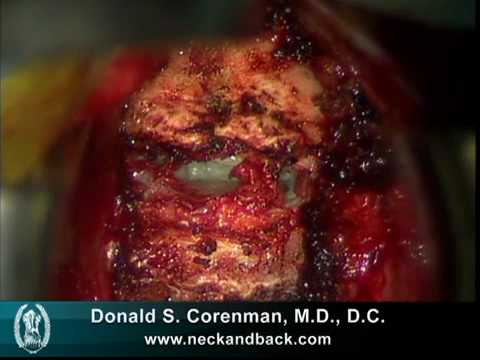 Live Surgical Video of Anterior Cervical Decompression & Fusion (ACDF)