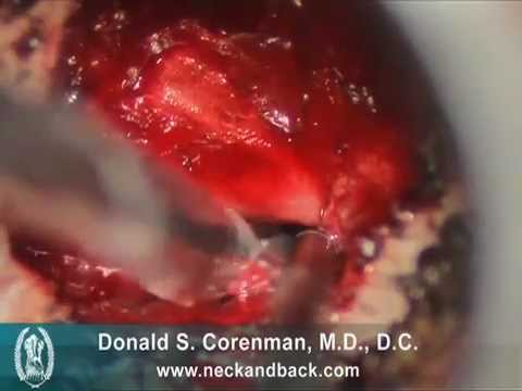 Posterior Cervical Foramenotomy