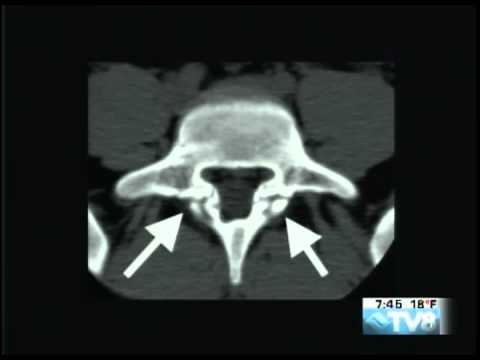 Stress Fracture of the Lumbar Spine