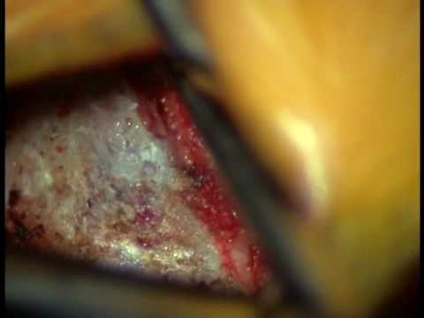 Surgical Video of L5-S1 Lumbar Microdiscectomy