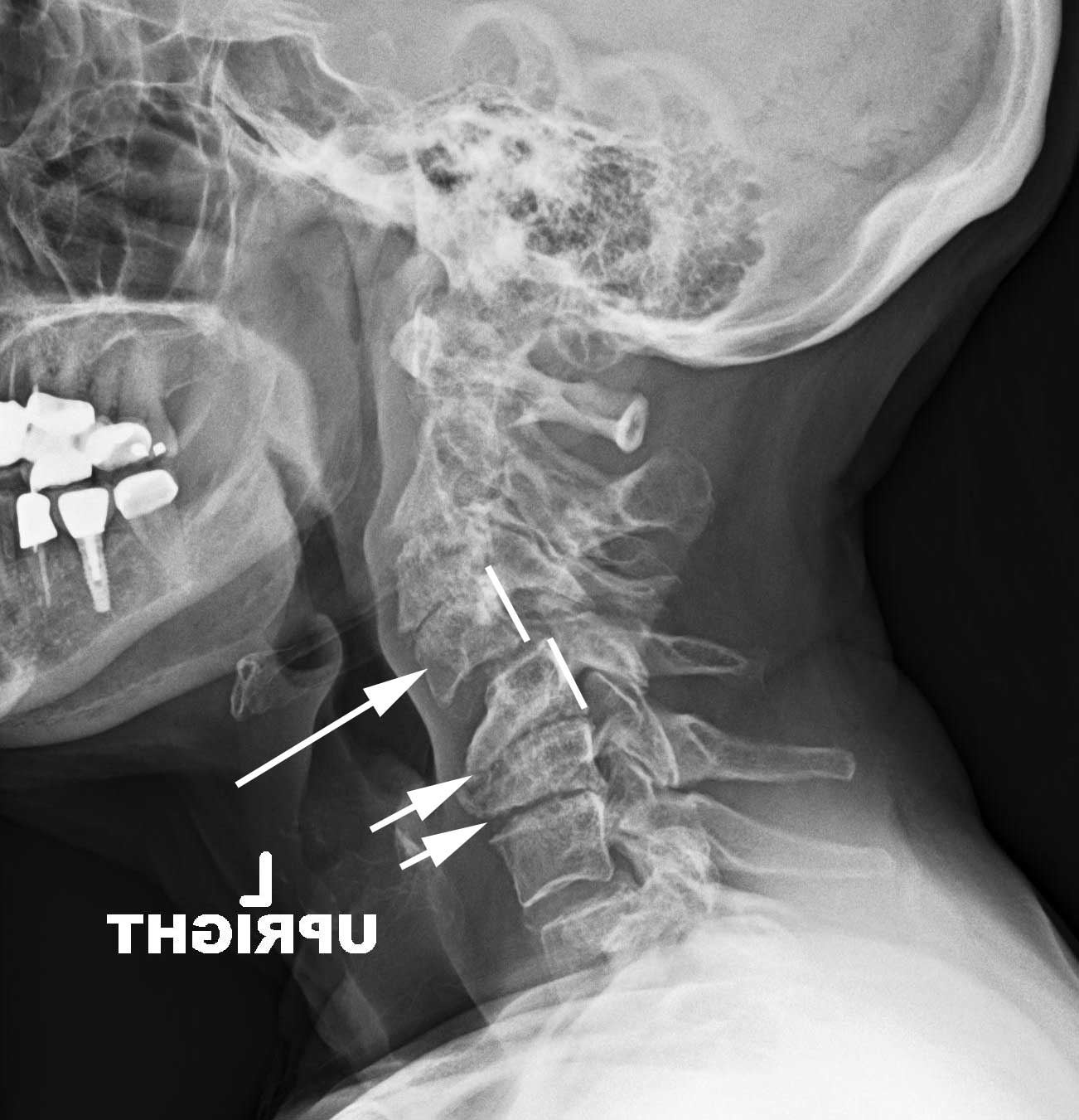 cervical spondylolisthesis x ray