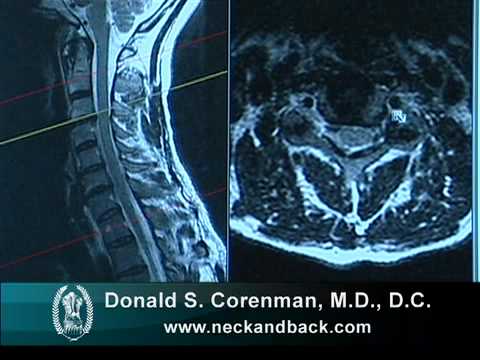 Understanding an MRI of Cervical Nerve Compression