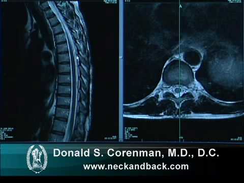 Understanding an MRI of the Normal Thoracic Spine