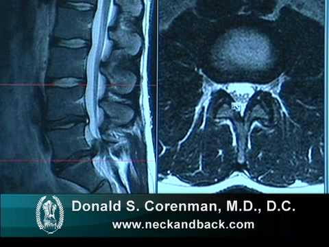 Understanding the MRI of a Lumbar Herniated Disc