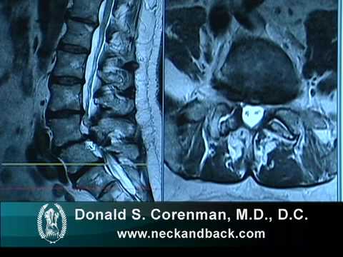 Understanding the MRI of Lumbar Degenerative Spondylolysthesis with Spinal Stenosis
