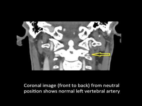 Vertebrobasilar Artery Syndrome