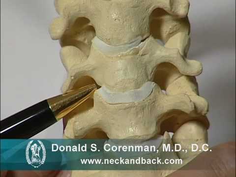 Cervical Foraminal Stenosis and Nerve Compression