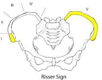 Risser Sign