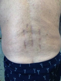 Two Level Minimally Invasive Lumbar Fusion Scars
