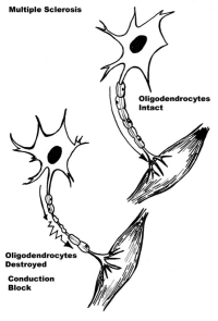 Multiple Sclerosis Nerves