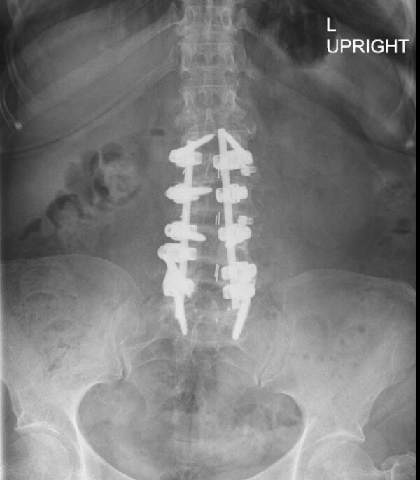 Far Lateral Lumbar Spine Fusions Oblique Lateral Interbody Fusion