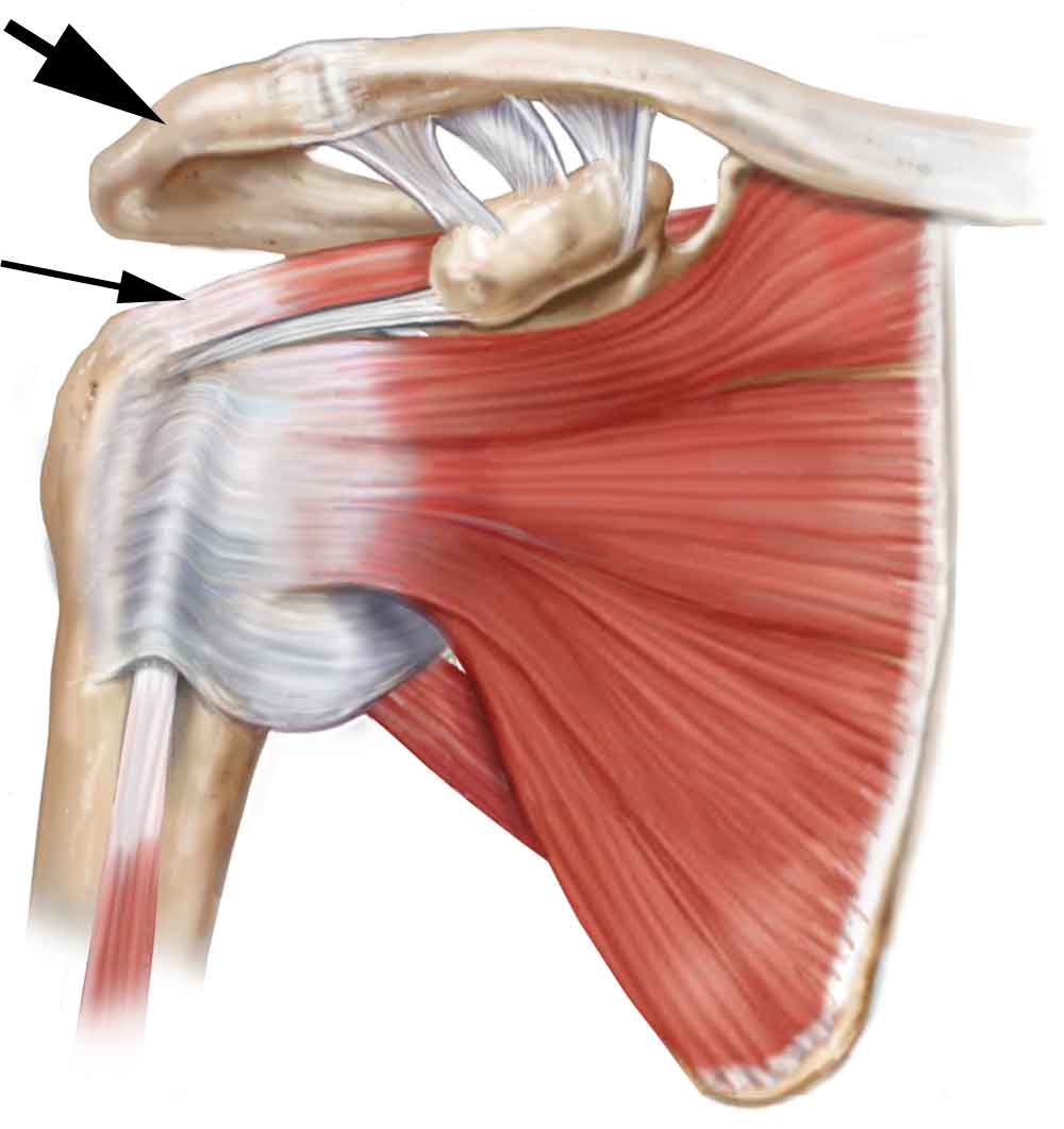 Rotator Cuff Syndrome | Spine Specialist | Vail, Aspen, Denver CO