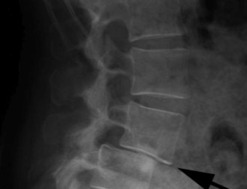 emg spine